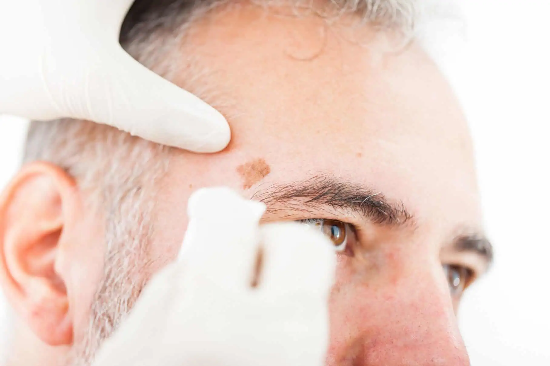Dermatologist examining mole on man's face.