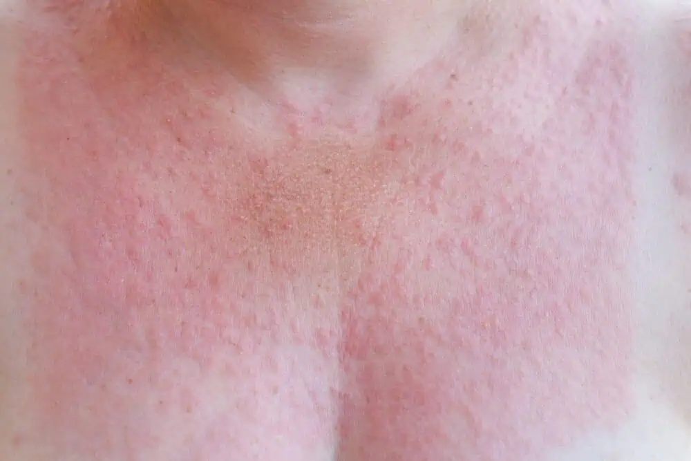 allergy rash on chest
