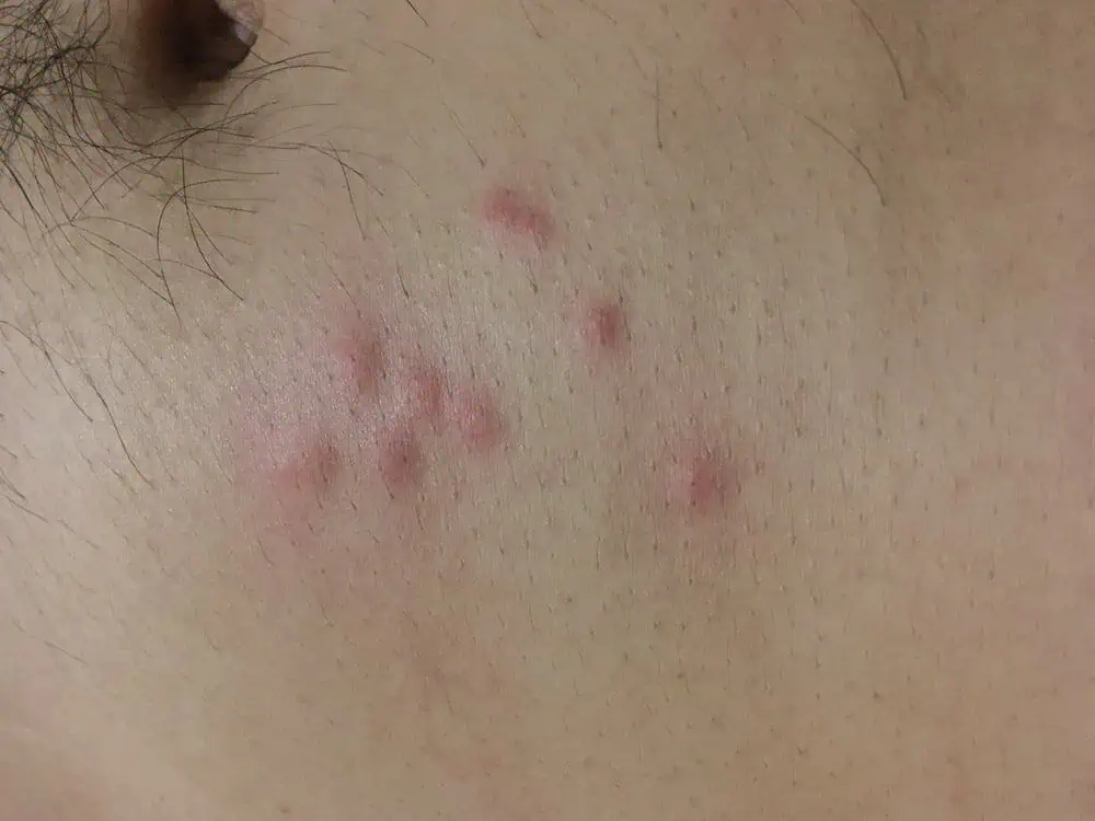 bed bug bites on skin