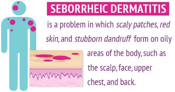 Infographic about the Best Treatment Seborrheic Dermatitis Treatment?