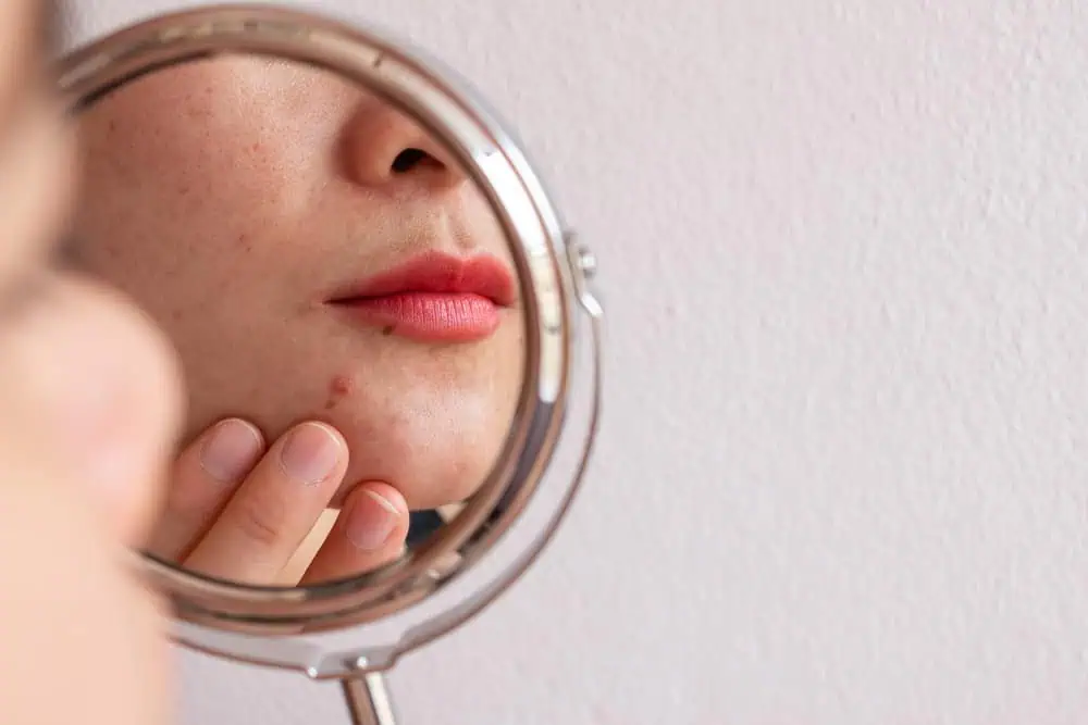 woman looks at acne on her chin in the mirror