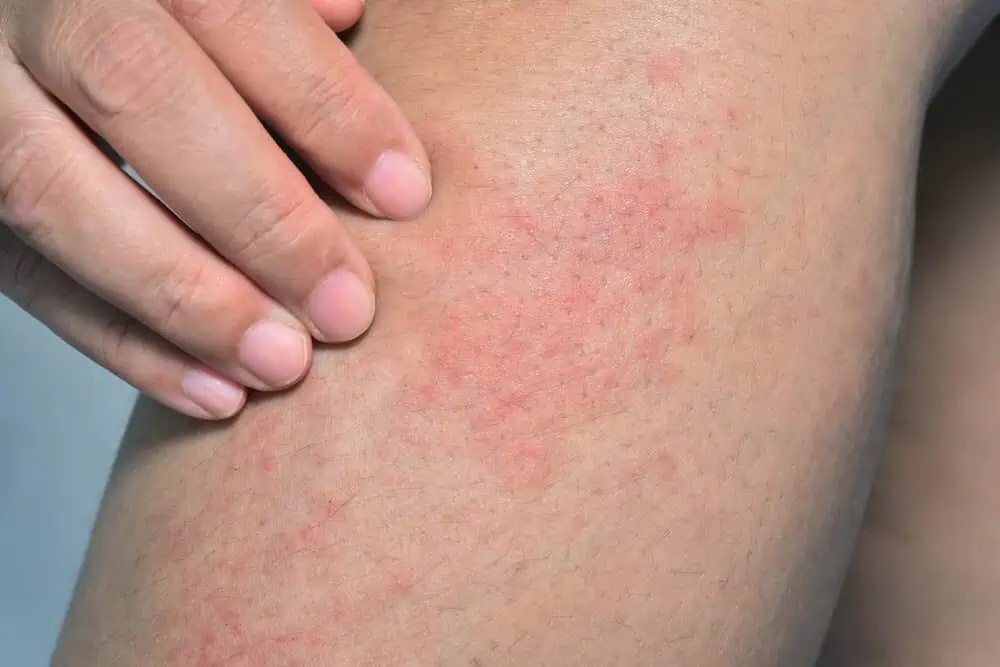 chlorine rash on a person's arm