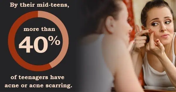 Infographic about how more than 40% of teens have acne or acne scarring