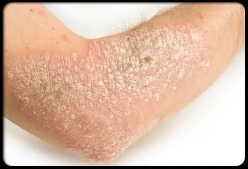 Psoriasis on the elbow