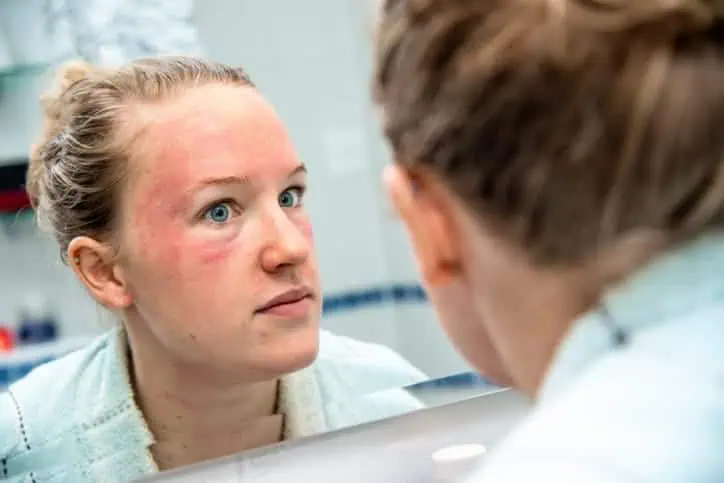 Woman looking in the mirror with red splotch on her face.