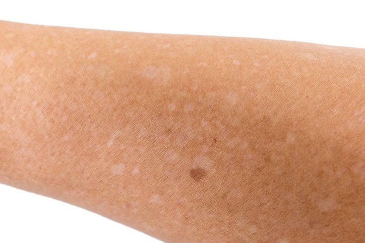 What Are the White Spots on My Skin? | Water's Edge
