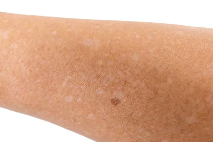 White spots on skin of a limb