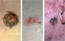 mohs skin cancer treatment