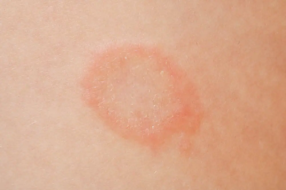 ringworm on skin