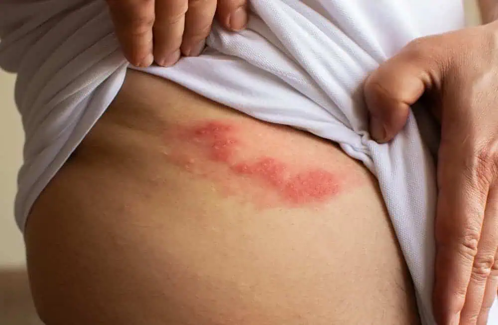 shingles rash on a person's torso