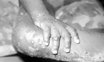 Monkey pox (original image from Wikipedia)