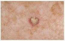 Sign of skin cancer on a patient's skin