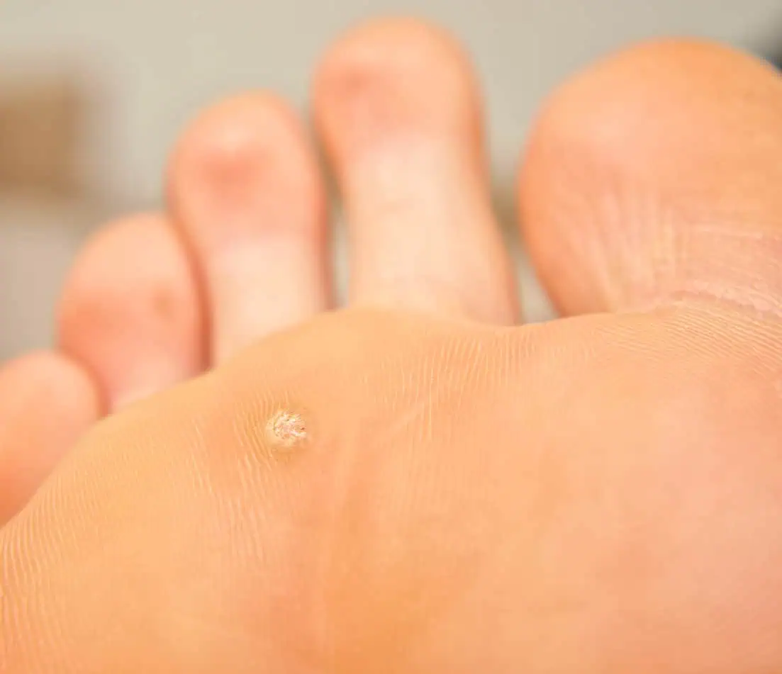 wart on the bottom of a foot