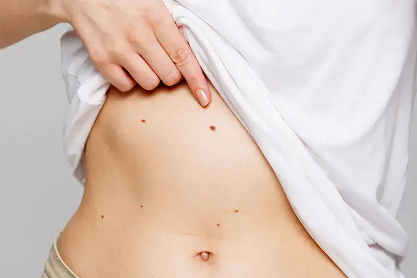 Woman lifts up a white t-shirt to show moles and freckles on her belly