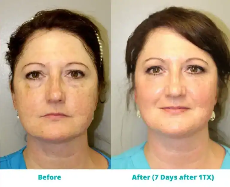 Subject 1 shown before and after treatment with CoolPeel.