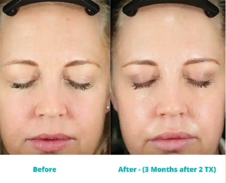 Subject 2 shown before and after treatment with CoolPeel.