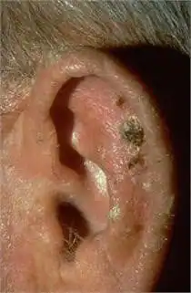Elderly man's ear with actinic keratosis or AK, from years of prolonged sun exposure.