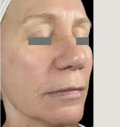 Subject 3, shown after one Sublative RF treatment.