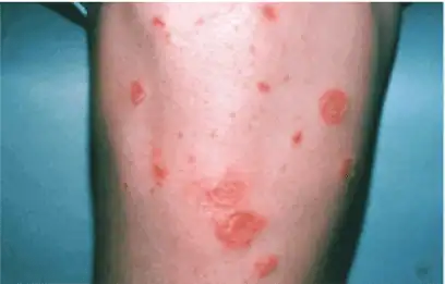 Nonbullous impetigo