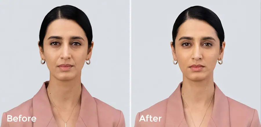 Subject 1 shown before and after treatment with RHA Collection fillers.