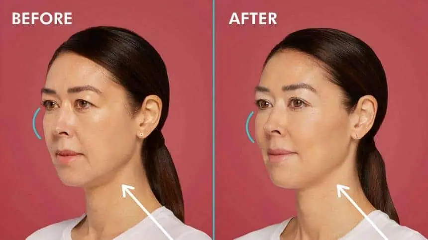 Subject 3 shown before and after Restylane Contour treatment.