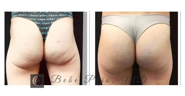 Subject 1, shown from behind before and after Sculptra Butt Lift treatment.