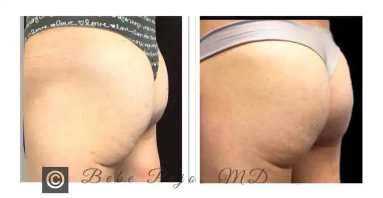 Subject 1, shown from the other side before and after Sculptra Butt Lift treatment.