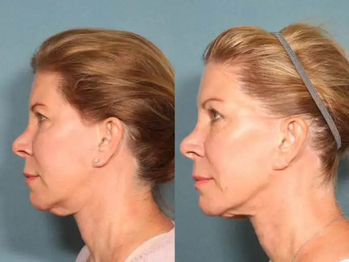 Subject 1 shown before and after treatment with Sofwave.
