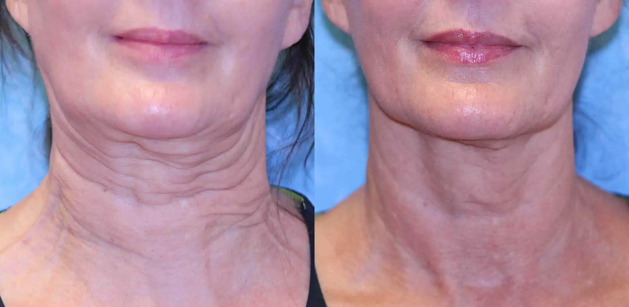 Subject 2 shown before and after treatment with Sofwave.