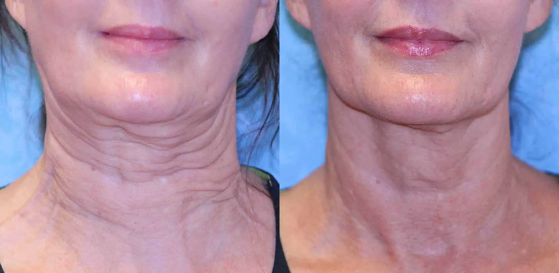 Subject 2 shown before and after treatment with Sofwave.