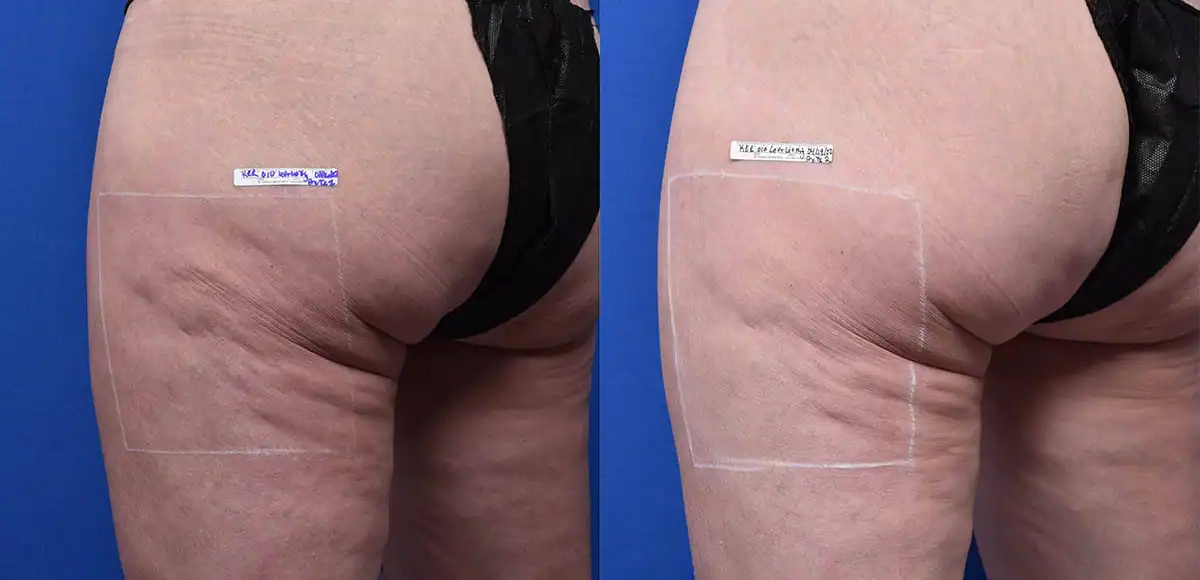 Subject 3 shown before and after treatment with Sofwave.