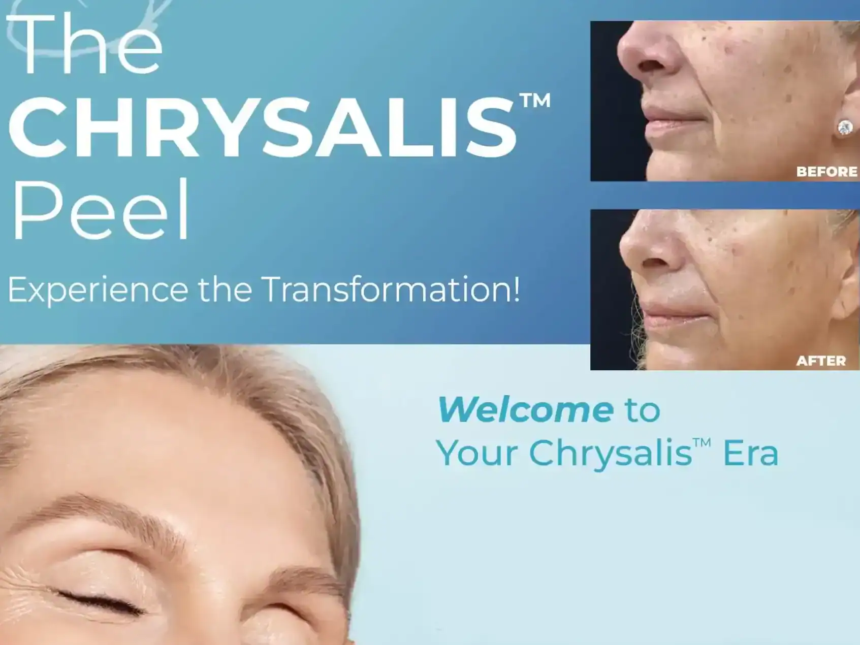 Horizontal version of Promotional flyer for Chrysalis treatment at Water's Edge