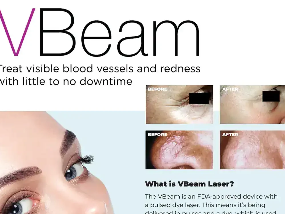 Promotion for VBeam Laser service