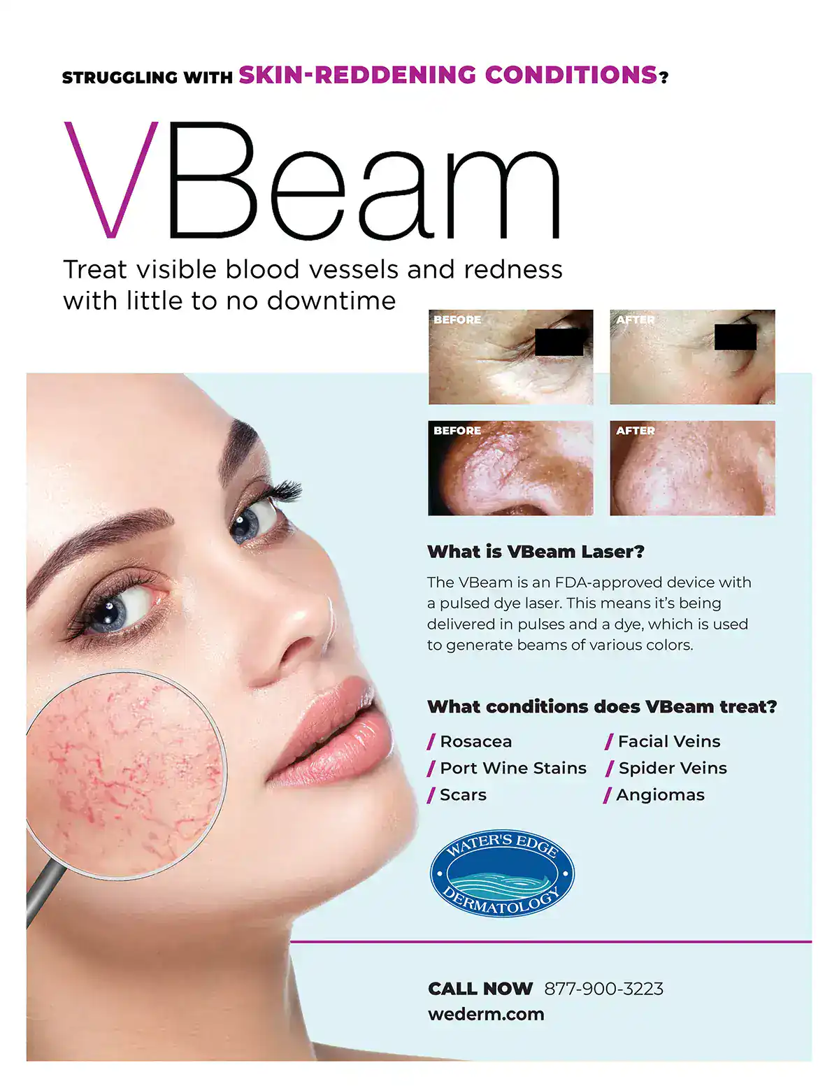 VBeam promotion to sign up for consultation