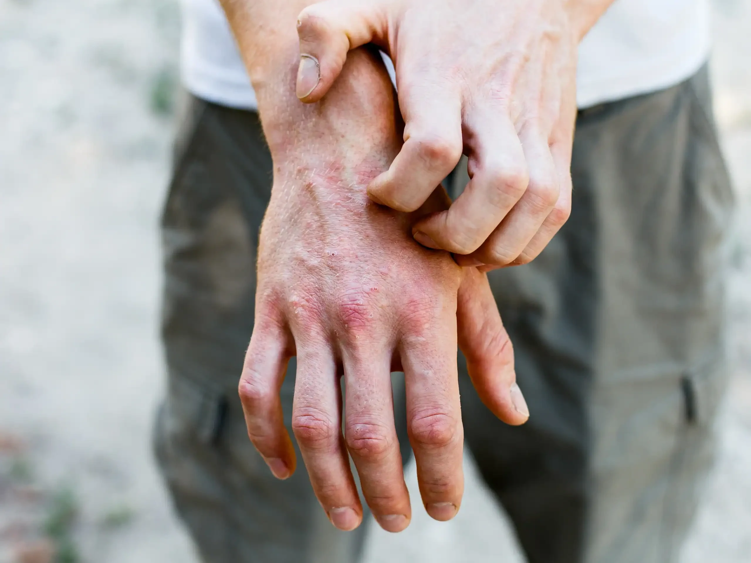 man scratches hands, which appear to have dermatitis or an allergic contact rash