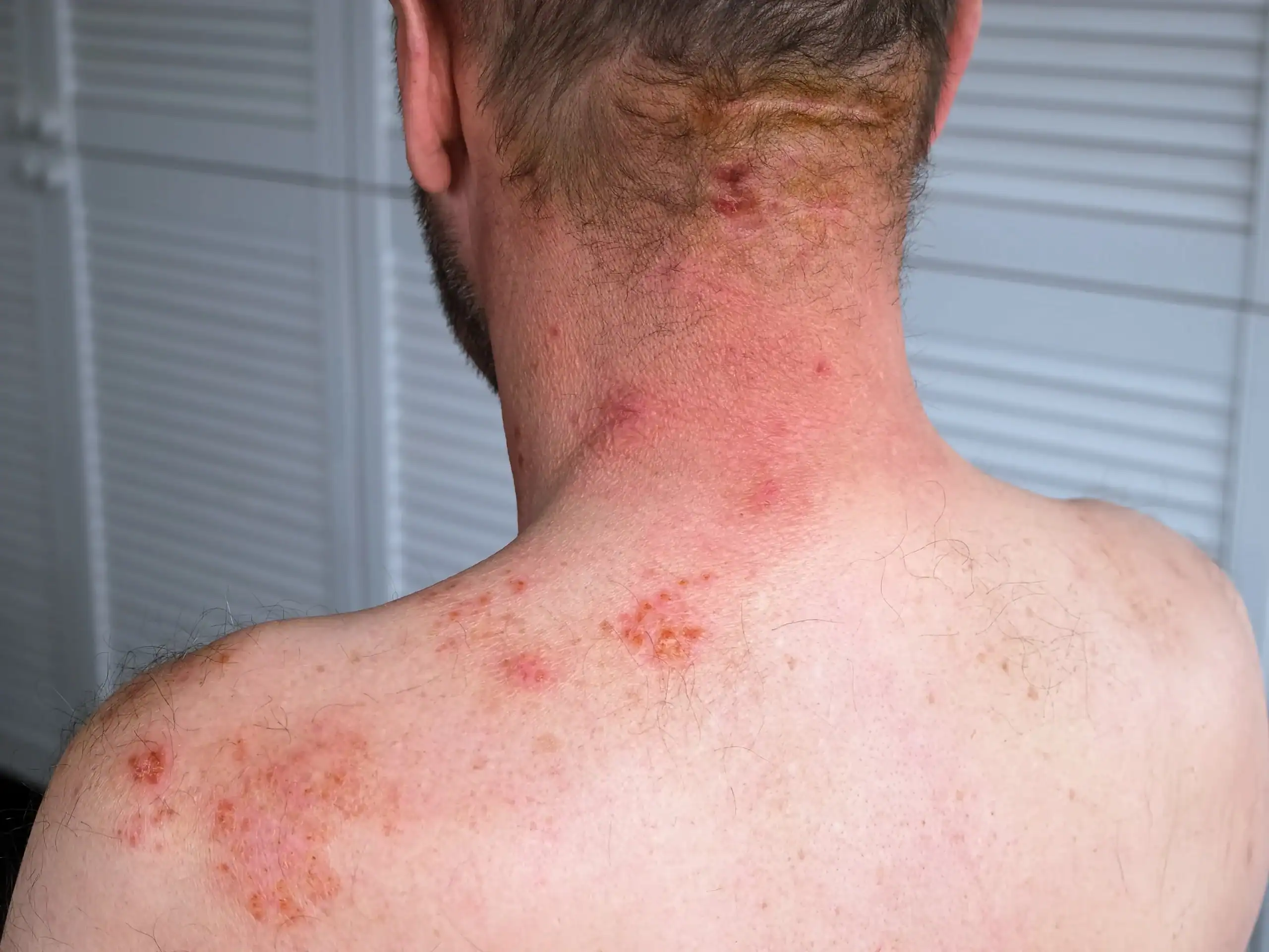 man with shingles herpes zoster rash on his back