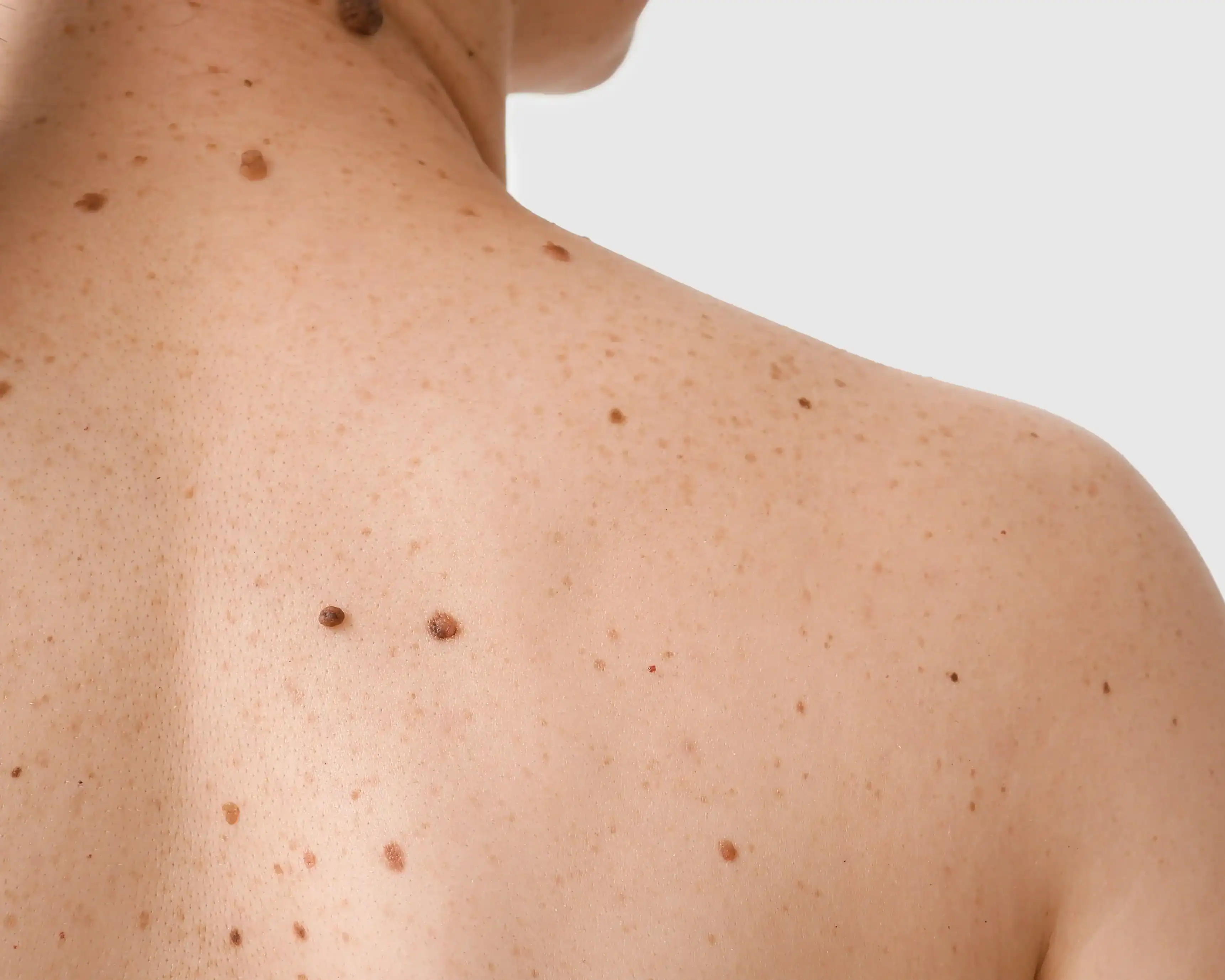 Woman with fair skin and many moles and freckles on her back