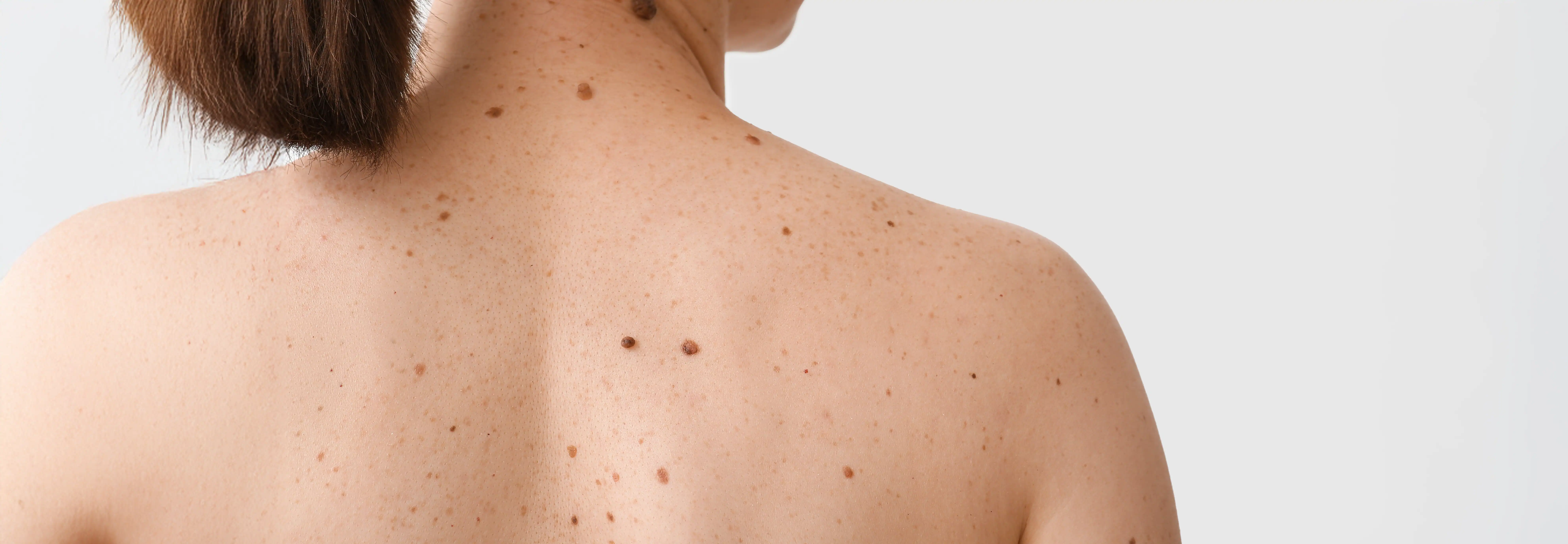Woman with fair skin and many moles and freckles on her back