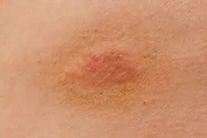 Early ringworm rash