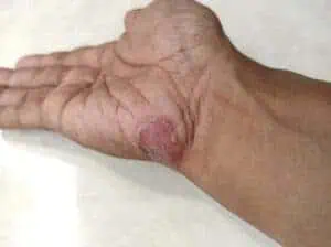 Ringworm on the hand