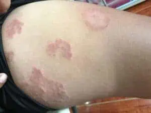 Ringworm rashes on a woman’s thigh