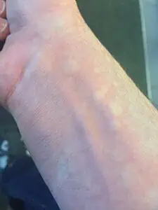 Hives, Urticaria treatment