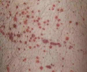 Purpura treatment