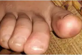 Acute Acro Ischemia treatment