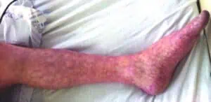 leg rash, Livedo reticularis treatment